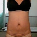 BEFORE ANY TUMMY TUCK (FRONT)