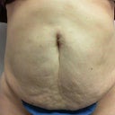 Tummy front before