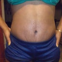 front view up close 13weeks post tt