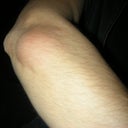 Dysport Elbow Welt. Got even bigger after pic. Benadryl was able to get rid of it.