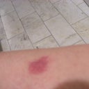Left Lower Leg Welt. This did not get bigger