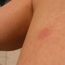 Left Upper Leg Welt. This did not get bigger