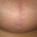 Scar on bottom of breast- barely noticeable (6 months)