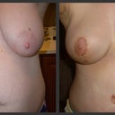 Before and After/Mommy Makeover