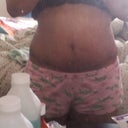 5 WEEKS POST OP SCAR FADING SLOWLY BUT SURLY