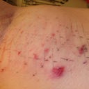 Left close up - some burning/bruising