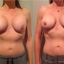 8 - 10 Weeks Post-Op