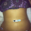 3 days post op