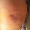 a bruise on my hip