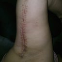 one arm one month after surgery 2 weeks after stitches came out...so far 6.25 inches are gone!