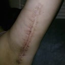one month out, 2 weeks after stitches out, still swollen and so far ~6.25 inches are gone