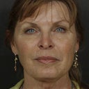 After Sculptra (and Dysport / Juvederm)