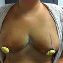 Five days post-op.