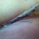 Six days post-op, left side.