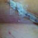 Six days post-op, right side.