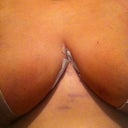 Six days post-op.