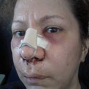 day after surgery