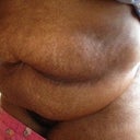 One week pre op