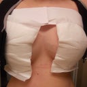 a few hours after surgery