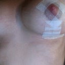 close up of right breast, the one that needed more lift and more 'work' (17 days after surgery)