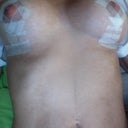 wounds healing (17 days)