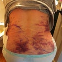 Day 2 PO. This is my lower back area - you can see all the bruising from the lipo on my lower back and on my flanks.