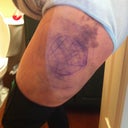 Day 2 PO. My left thigh - I had lipo done there, too.