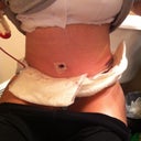 Day 2 PO. I'm really swollen. My incision is pretty low, which is nice. It feels weird without my binder on, I like the security of it, even though it is uncomfortable.