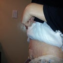 left side 4th day post op
