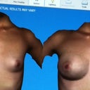 Before picture is clearly on the left and the right is what the doctor thinks they will look like after (they will big a little bigger than this)