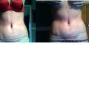 Left Day 10 and Right Day 21-- I look bigger on day 21 ughh!