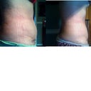 Left side day 10 and right side day 21-- funny how all I can see is the swelling and flaws...I even annoy myself! haha