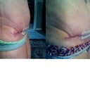Left side day 10 right side day 21
