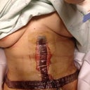 1day post op. feeling good!