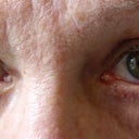 eyes after surgery,cropped.jpg