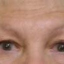 ta eyes before facelift.jpg
