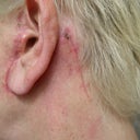 ta neck scars.JPG
