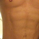 Four weeks post surgery. Went to the beach for the first time today and felt good although slightly paranoid that the scars were still so noticeable. Can't wait for them to fade so I can confidently take my top off. Dr. Lanzer did a great job creating a natural looking result - just like I asked him to do.