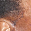June 22, Two Days Post-Op, Sutures