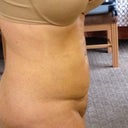 Side view - two weeks. This is the side with a bit more swelling.