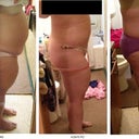 Yay! Swelling is still going down so I'm slowly getting flatter. This is my before, day 4 po, and day 9 po side views. In this photo I still have a lot of pads covering the drain hole on my lower abdomen (in my underwear!). That's why there is such a large pooch in the front of my undies - it's about 3 inches worth of padding, not swelling.