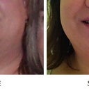 Front view of chin before lipo and 5 days po.