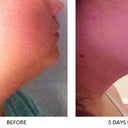 Side view of chin before lipo and 5 days po. Sorry, this one is kind if fuzzy. The difference isn't as pronounced on the side view as it is on the front, but I'm also still swollen so it should go down more.