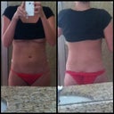 Day 2 : Post-Op lipo of flank area