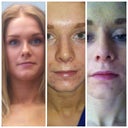 Prior nose curved and tip was crooked. Five days so straight still swollen. Two weeks less swelling