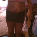 Front view Before tummy tuck