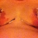 Day 1 post op