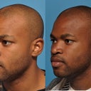 Before And 6 Months After African-American Rhinoplasty