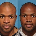 Before And 6 Months After African-American Rhinoplasty