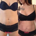 2.5 weeks post op Before/After picture